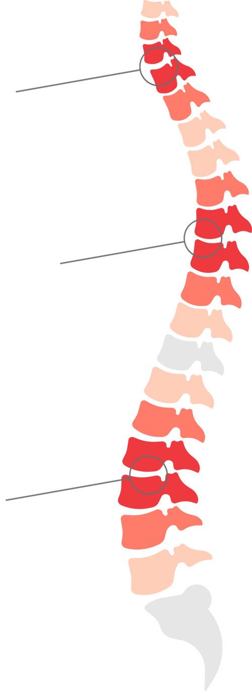 Spine Chart