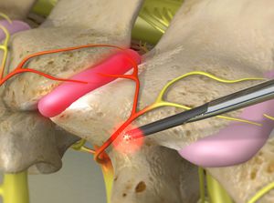 cervfacetneurotomy_300