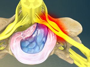 cervherniadisc_300