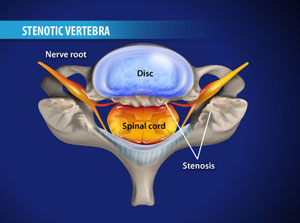 cervlaminectomy_300