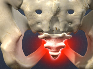 coccydynia_300