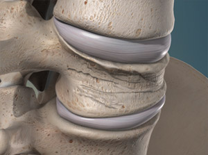 compressionfractures_300