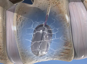kyphoplasty_300
