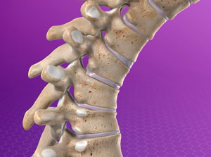 kyphosis_300