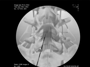 lumepisteroid_300