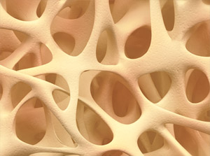 osteoporosis_300