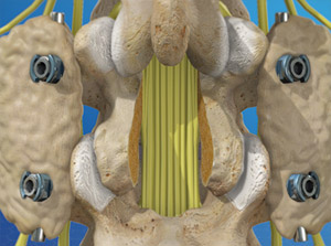 spinalfusion_300