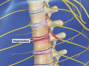 spinalstenosisthoracic_300