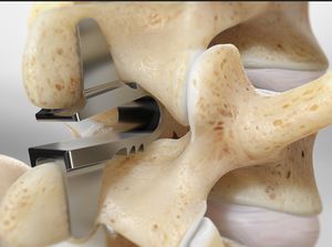 spinestabilizecoflex_300