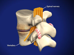 spondylosis_300